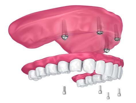 Dental Implants The Villages, FL .